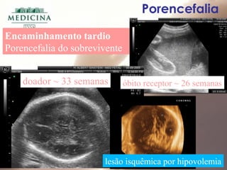 doador ~ 33 semanas
Encaminhamento tardio
Porencefalia do sobrevivente
óbito receptor ~ 26 semanas
lesão isquêmica por hipovolemia
Porencefalia
 