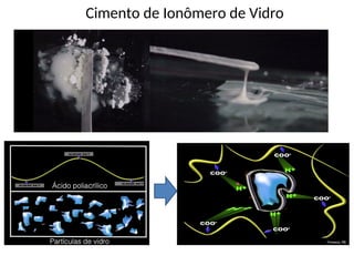 Cimento de Ionômero de Vidro
 