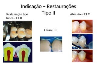 Indicação – Restaurações
Tipo II
Classe III
Restauração tipo
tunel – Cl II
Abrasão – Cl V
 