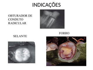 INDICAÇÕES
FORRO
OBTURADOR DE
CONDUTO
RADICULAR
SELANTE
 