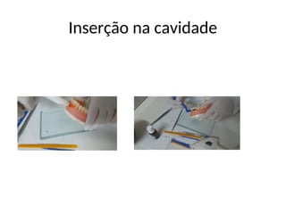 Inserção na cavidade
 