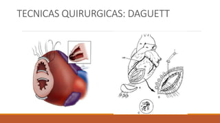 TECNICAS QUIRURGICAS: DAGUETT
 