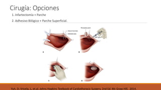 Cirugía: Opciones
1. Infartectomía + Parche
2. Adhesivo Bilógico + Parche Superficial.
Yuh, D; Vricela, L, et.al. Johns Hopkins Textbook of Cardiothoracic Surgery. 2nd Ed. Mc Graw Hill, 2014.
 