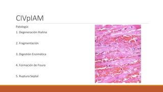 CIVpIAM
Patología:
1. Degeneración Hialina
2. Fragmentación
3. Digestión Enzimática
4. Formación de Fisura
5. Ruptura Septal
 