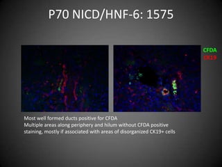 P70 NICD/HNF-6: 1575CFDACK19Most well formed ducts positive for CFDAMultiple areas along periphery and hilum without CFDA positive staining, mostly if associated with areas of disorganized CK19+ cells