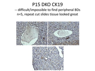 P15 DKO CK19-- difficult/impossible to find peripheral BDsn=5, repeat cut slides tissue looked great 