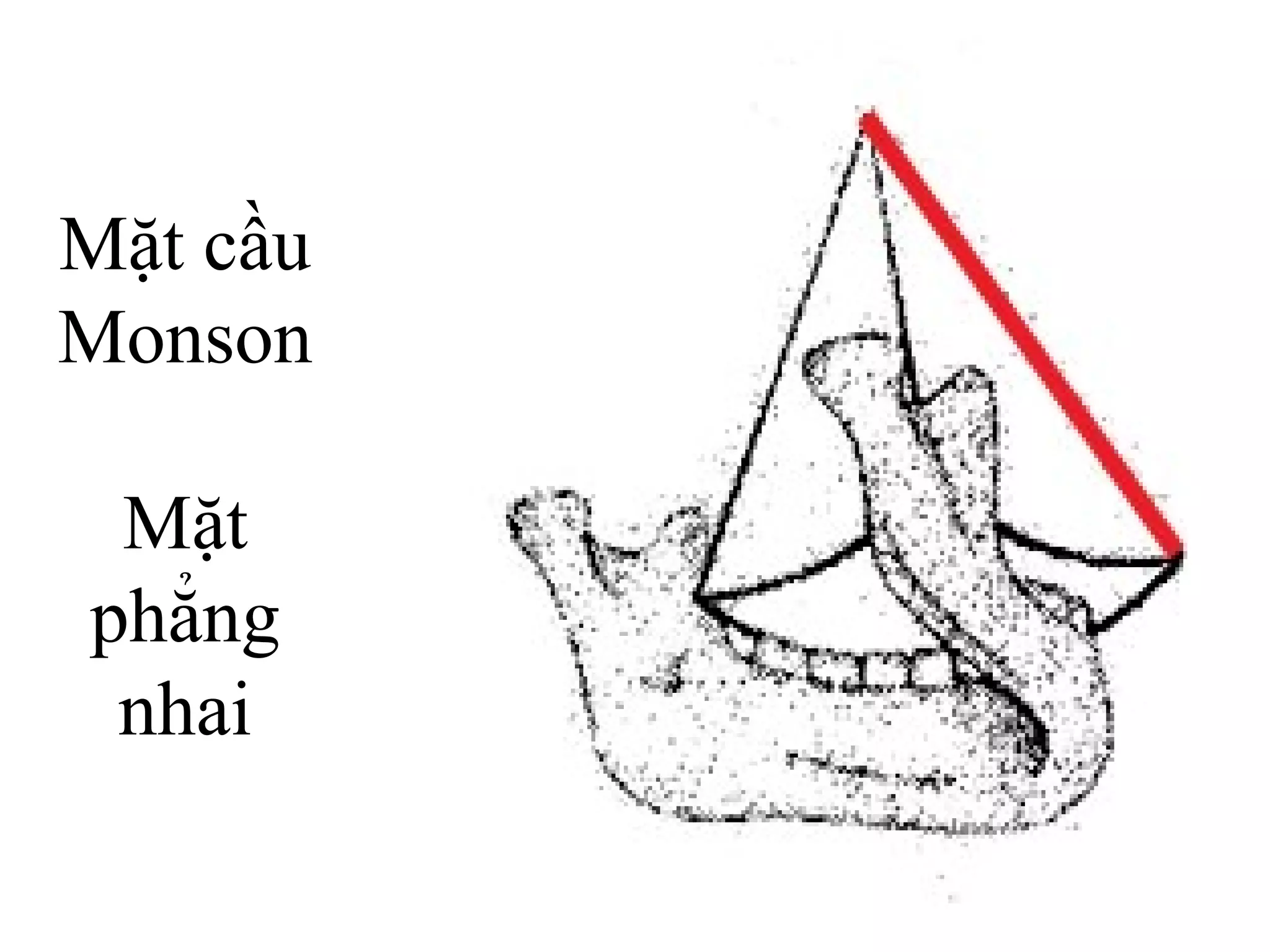 Mặt cầu
Monson

 Mặt
phẳng
 nhai
 