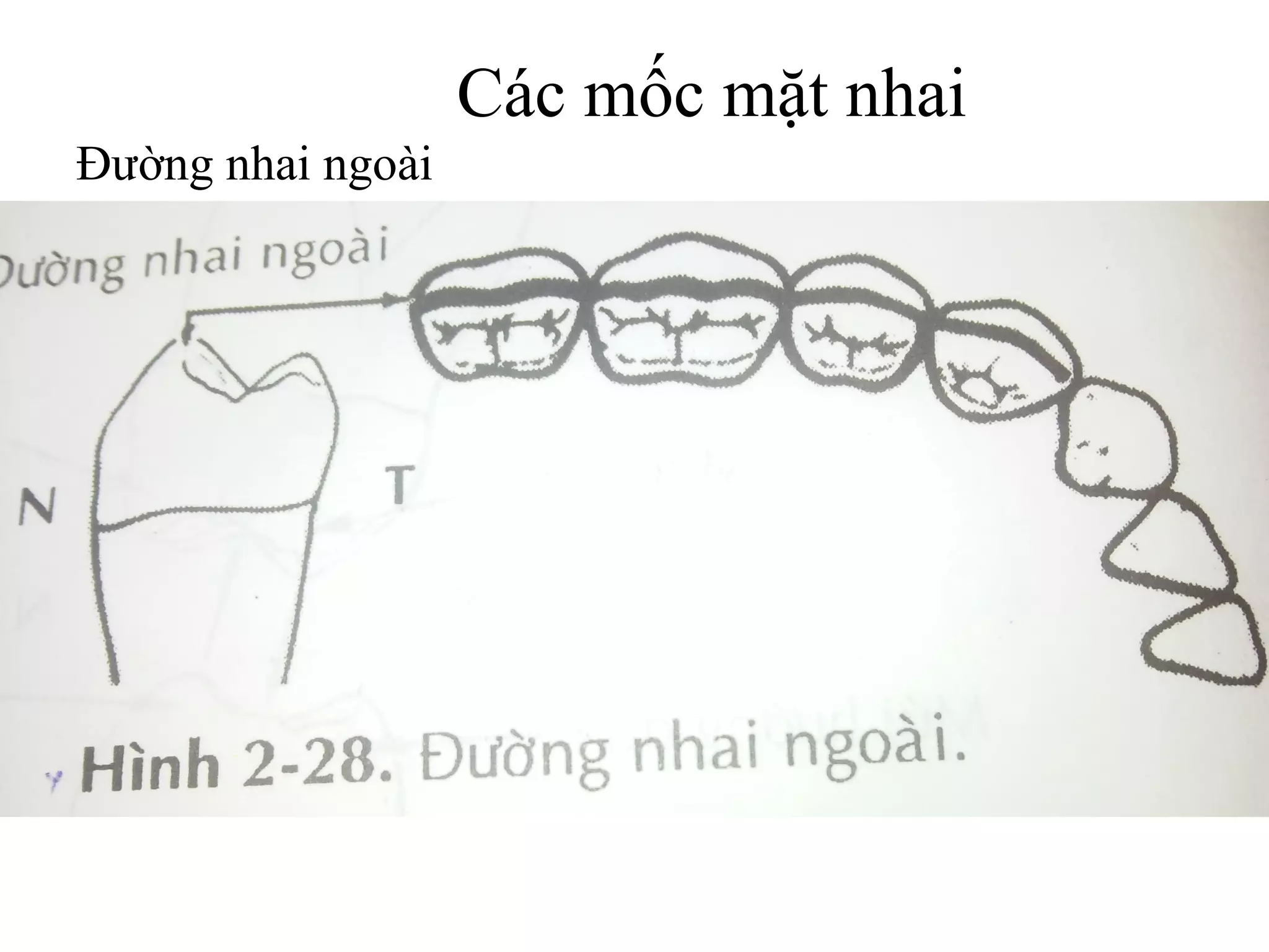Các mốc mặt nhai
Đường nhai ngoài
 