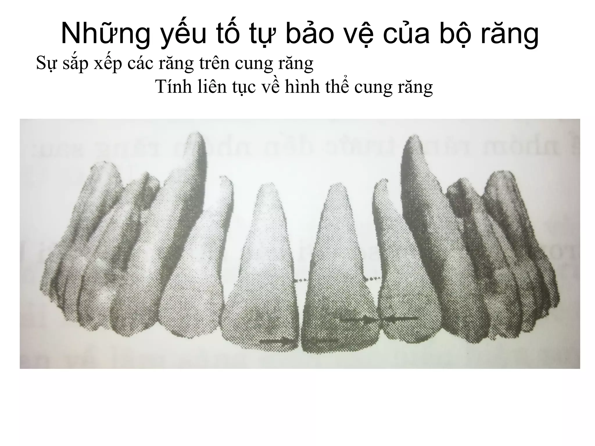 Những yếu tố tự bảo vệ của bộ răng
Sự sắp xếp các răng trên cung răng
              Tính liên tục về hình thể cung răng
 
