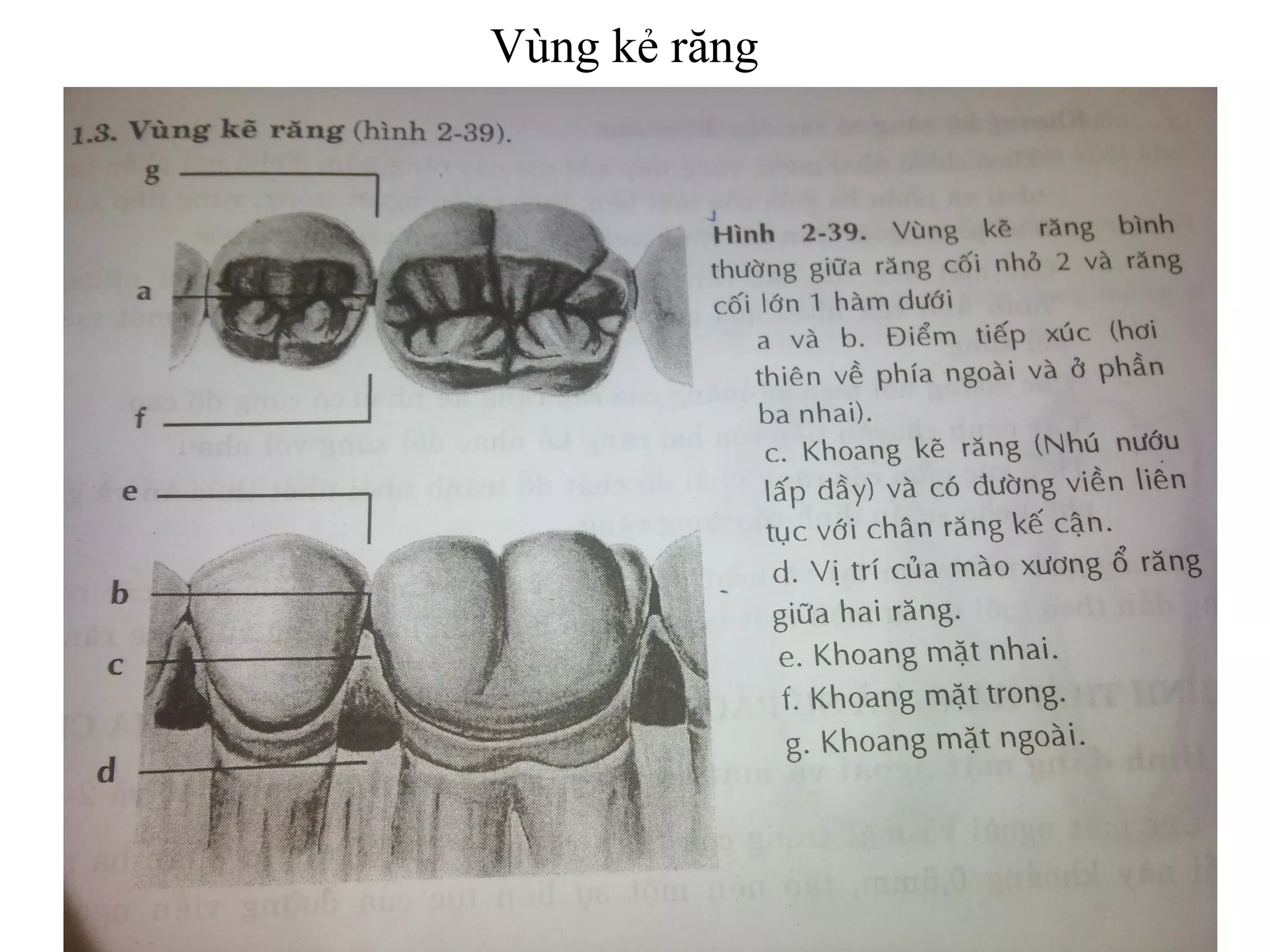 Vùng kẻ răng
 