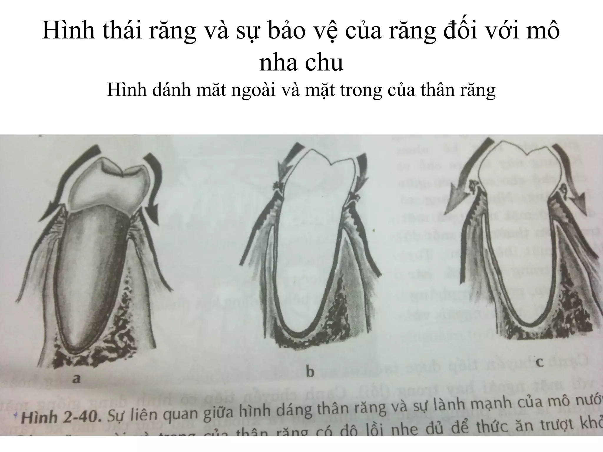 Hình thái răng và sự bảo vệ của răng đối với mô
                    nha chu
     Hình dánh măt ngoài và mặt trong của thân răng
 