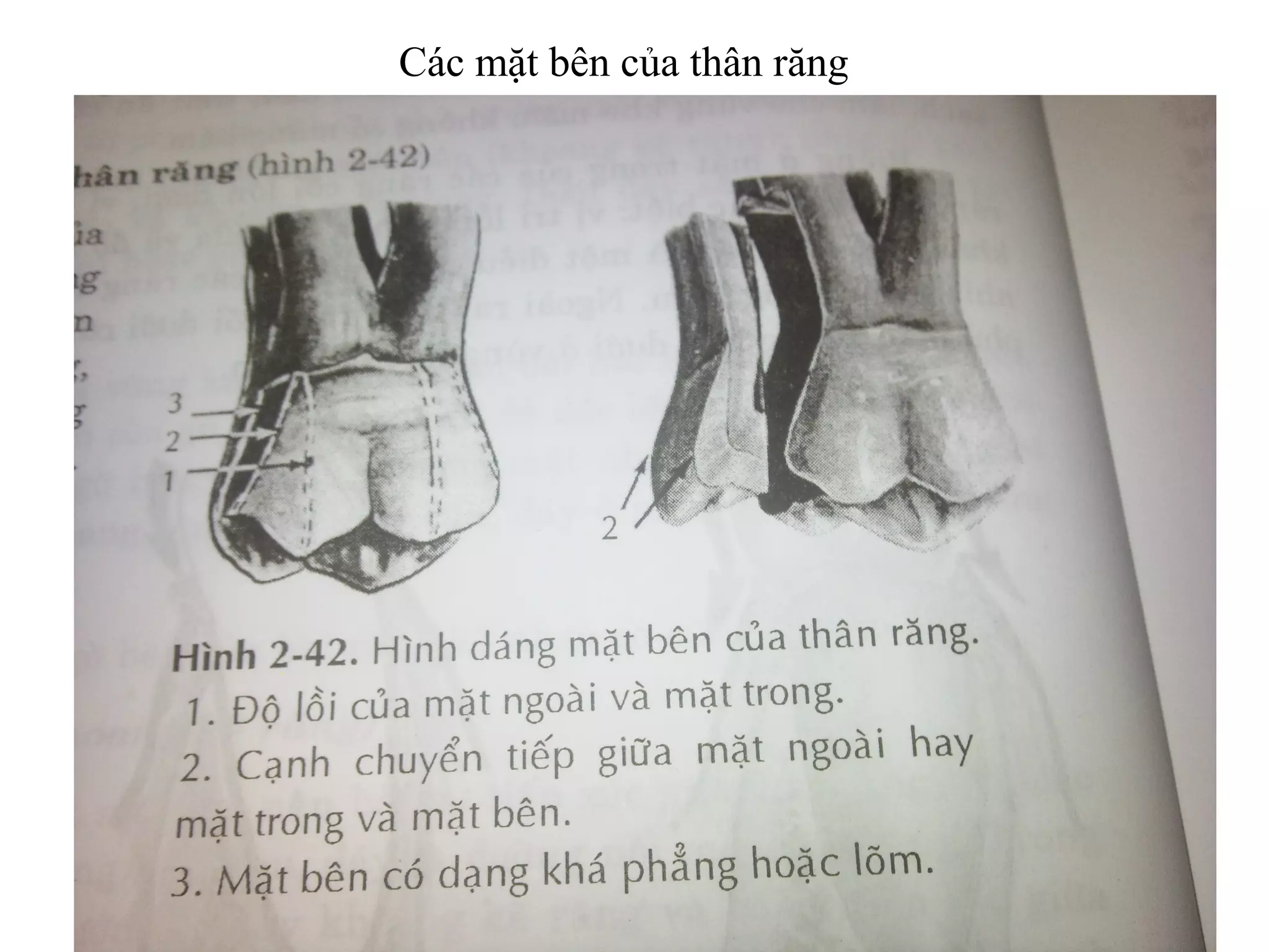 Các mặt bên của thân răng
 