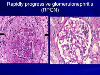 Chronic Kidney Disease: Diagnosis and management | PPT
