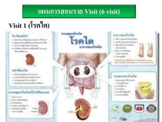 Visit 1 (โรคไต)
แผนการสอนราย Visit (6 visit)
 