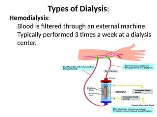 Types of Dialysis:
Hemodialysis:
Blood is filtered through an external machine.
Typically performed 3 times a week at a dialysis
center.
 