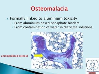  Formally linked to aluminium toxicity
◦ From aluminium based phosphate binders
◦ From contamination of water in dialysate solutions
unmineralised osteoid
 
