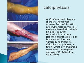 • A, Confluent calf plaques
(borders shown with
arrows). Parts of the skin
are erythematous, which is
easily confused with simple
cellulitis. B, Gross
ulceration in the same
patient 3 months later. The
black eschar has been
surgically débrided. C,
Calciphylactic plaques, a
few of which are beginning
to ulcerate. (Photographs
courtesy of Dr. Adrian Fine.
Up To Date)
 