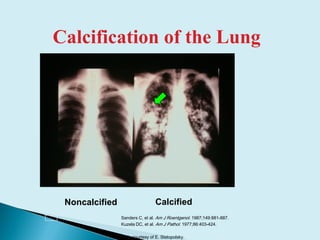 Calcification of the Lung
Sanders C, et al. Am J Roentgenol. 1987;149:881-887.
Kuzela DC, et al. Am J Pathol. 1977;86:403-424.
Slide courtesy of E. Slatopolsky.
CalcifiedNoncalcified
 