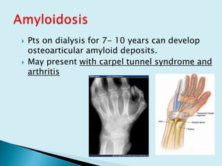 Pts on dialysis for 7- 10 years can develop
osteoarticular amyloid deposits.
 May present with carpel tunnel syndrome and
arthritis
 