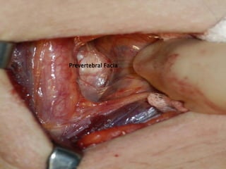 Prevertebral Facia
 
