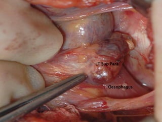 LT Sup Para
Oesophagus
 