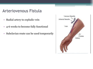 Arteriovenous Fistula
• Radial artery to cephalic vein
• 4-6 weeks to become fully functional
• Subclavian route can be used temporarily
 