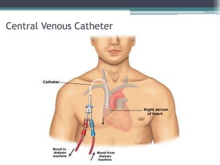 Central Venous Catheter
 