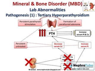 CKD MBD chronic kidney disease mineral bone disease Dr. Abdel Rahman ...