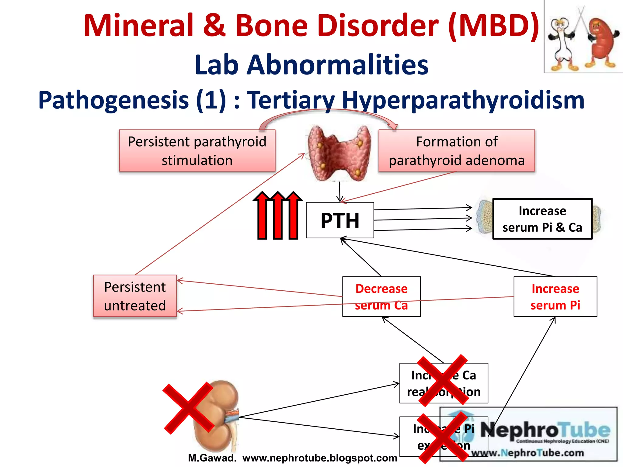 Increase Ca
reabsorption
PTH
Increase Pi
excretion
Mineral & Bone Disorder (MBD)
Lab Abnormalities
Pathogenesis (1) : Tertiary Hyperparathyroidism
Decrease
serum Ca
Increase
serum Pi
Persistent
untreated
Persistent parathyroid
stimulation
Formation of
parathyroid adenoma
Increase
serum Pi & Ca
M.Gawad. www.nephrotube.blogspot.com
 