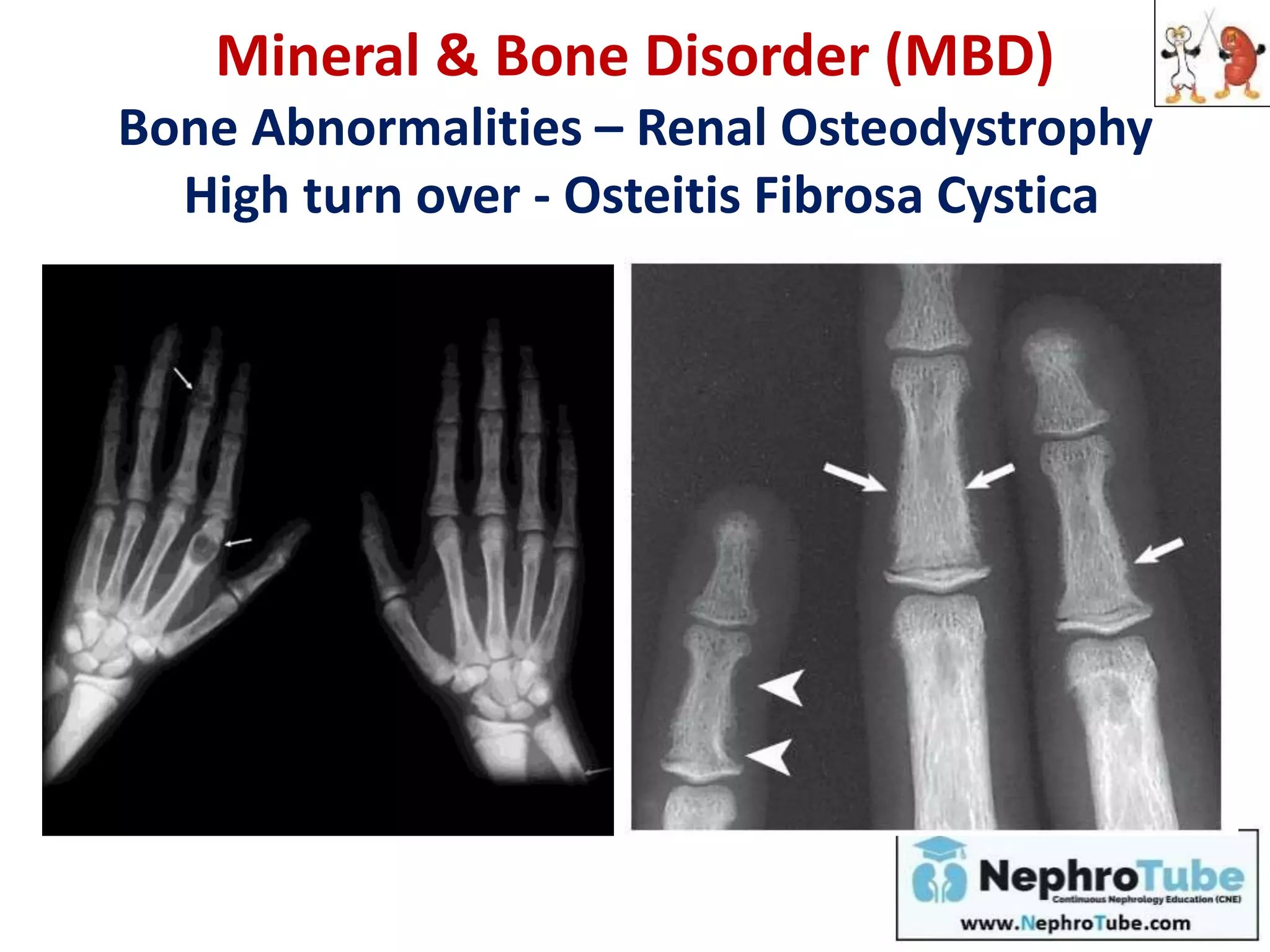 Mineral & Bone Disorder (MBD)
Bone Abnormalities – Renal Osteodystrophy
High turn over - Osteitis Fibrosa Cystica
 