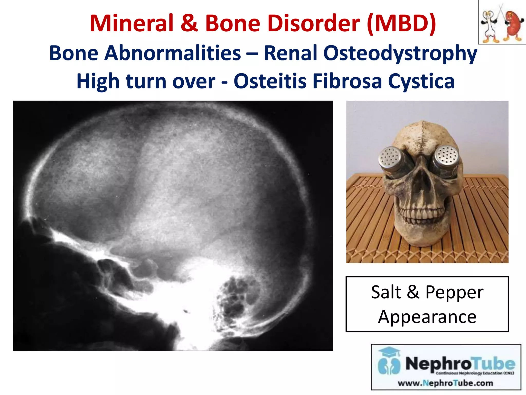 Mineral & Bone Disorder (MBD)
Bone Abnormalities – Renal Osteodystrophy
High turn over - Osteitis Fibrosa Cystica
Salt & Pepper
Appearance
 