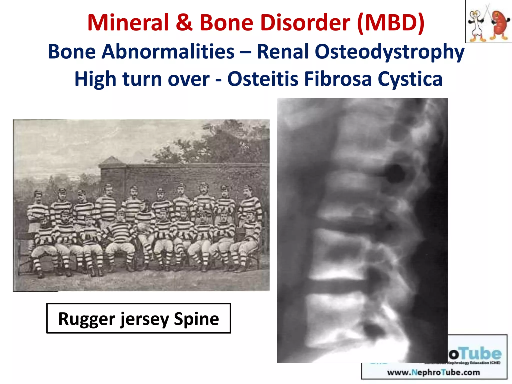Mineral & Bone Disorder (MBD)
Bone Abnormalities – Renal Osteodystrophy
High turn over - Osteitis Fibrosa Cystica
Rugger jersey Spine
 