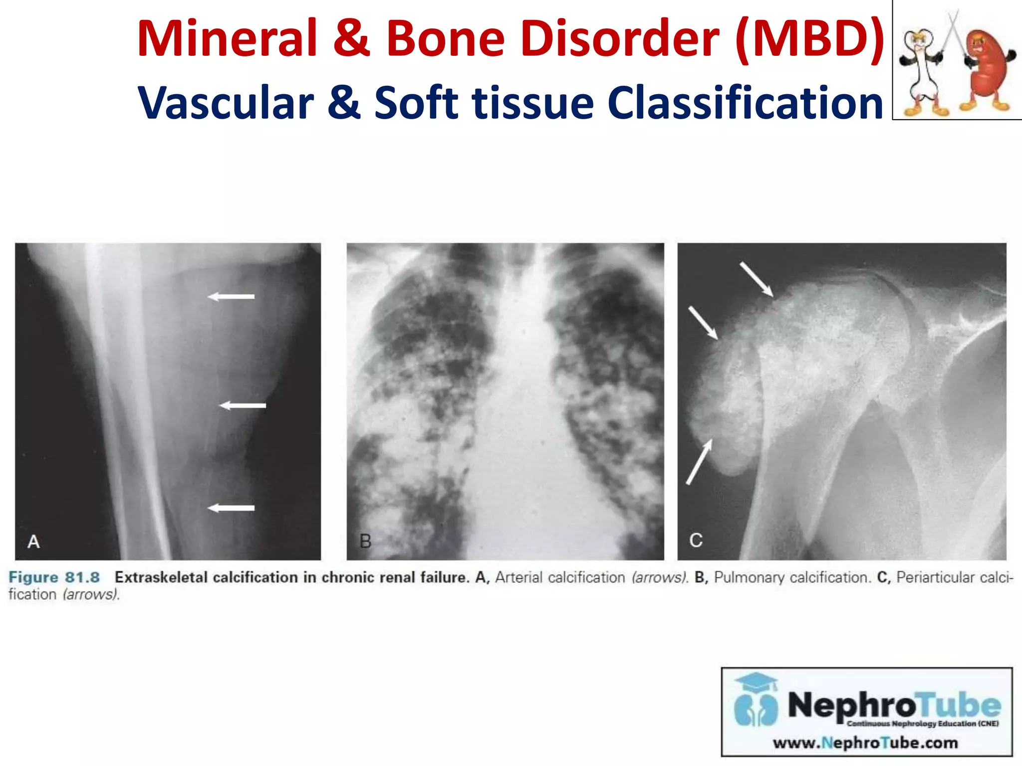 Mineral & Bone Disorder (MBD)
Vascular & Soft tissue Classification
PTH – Vit D – Ca – Pi Axis
 