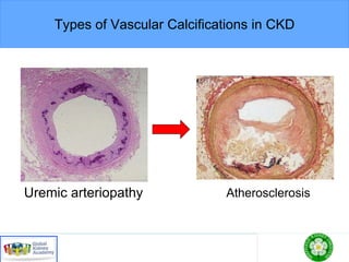 Types of Vascular Calcifications in CKD
Uremic arteriopathy Atherosclerosis
 