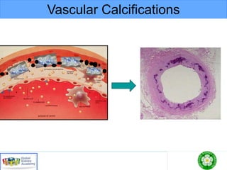 Vascular Calcifications
 
