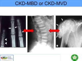 CKD-MBD or CKD-MVD
 