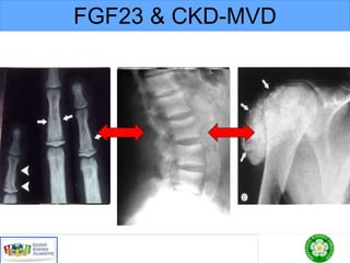 FGF23 & CKD-MVD
 