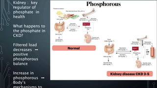 Kidney : key
regulator of
phosphate in
health
What happens to
the phosphate in
CKD?
Filtered load
decreases ➡️
positive
phosphorous
balance
Increase in
phosphorous ➡️
Body’s
 