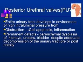 Posterior Urethral valves(PUV) 
Entire urinary tract develops in environment 
of high intraluminal pressure from 
Obstruction ®Cell apoptosis, inflammation 
Permanent defects - parenchymal dysplasia 
of kidneys, ureters, bladder despite adequate 
decompression of the urinary tract pre or post 
natally 
 