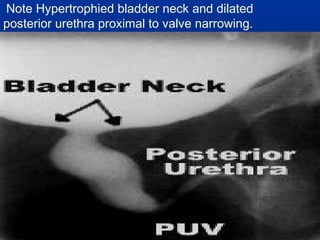 Note Hypertrophied bladder neck and dilated 
posterior urethra proximal to valve narrowing. 
 