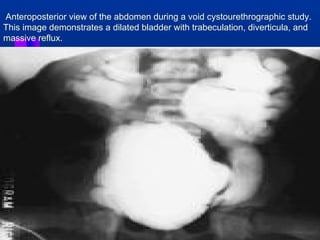 Anteroposterior view of the abdomen during a void cystourethrographic study. 
This image demonstrates a dilated bladder with trabeculation, diverticula, and 
massive reflux. 
 