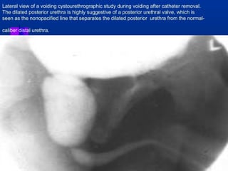 Lateral view of a voiding cystourethrographic study during voiding after catheter removal. 
The dilated posterior urethra is highly suggestive of a posterior urethral valve, which is 
seen as the nonopacified line that separates the dilated posterior urethra from the normal-caliber 
distal urethra. 
 