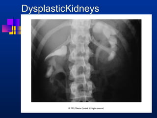 DysplasticKidneys 
 