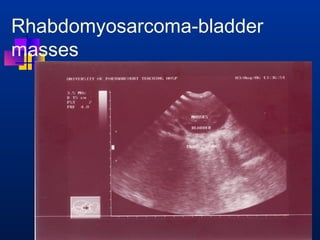 Rhabdomyosarcoma-bladder 
masses 
 