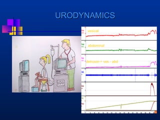 UURROODDYYNNAAMMIICCSS 
vesical 
abdominal 
detrusor-= ves - abd 
 