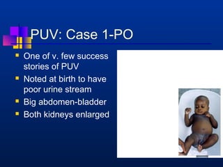 PUV: Case 1-PO 
 One of v. few success 
stories of PUV 
 Noted at birth to have 
poor urine stream 
 Big abdomen-bladder 
 Both kidneys enlarged 
 