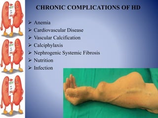 CHRONIC COMPLICATIONS OF HD
 Anemia
 Cardiovascular Disease
 Vascular Calcification
 Calciphylaxis
 Nephrogenic Systemic Fibrosis
 Nutrition
 Infection
 