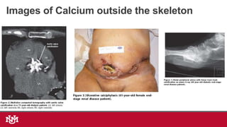 Images of Calcium outside the skeleton
 