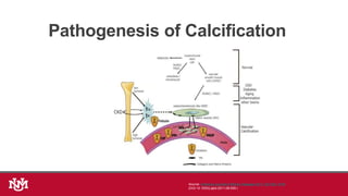Figure 5
Source: American Journal of Kidney Diseases 2011; 58:1022-1036
(DOI:10.1053/j.ajkd.2011.08.009 )
Pathogenesis of Calcification
 