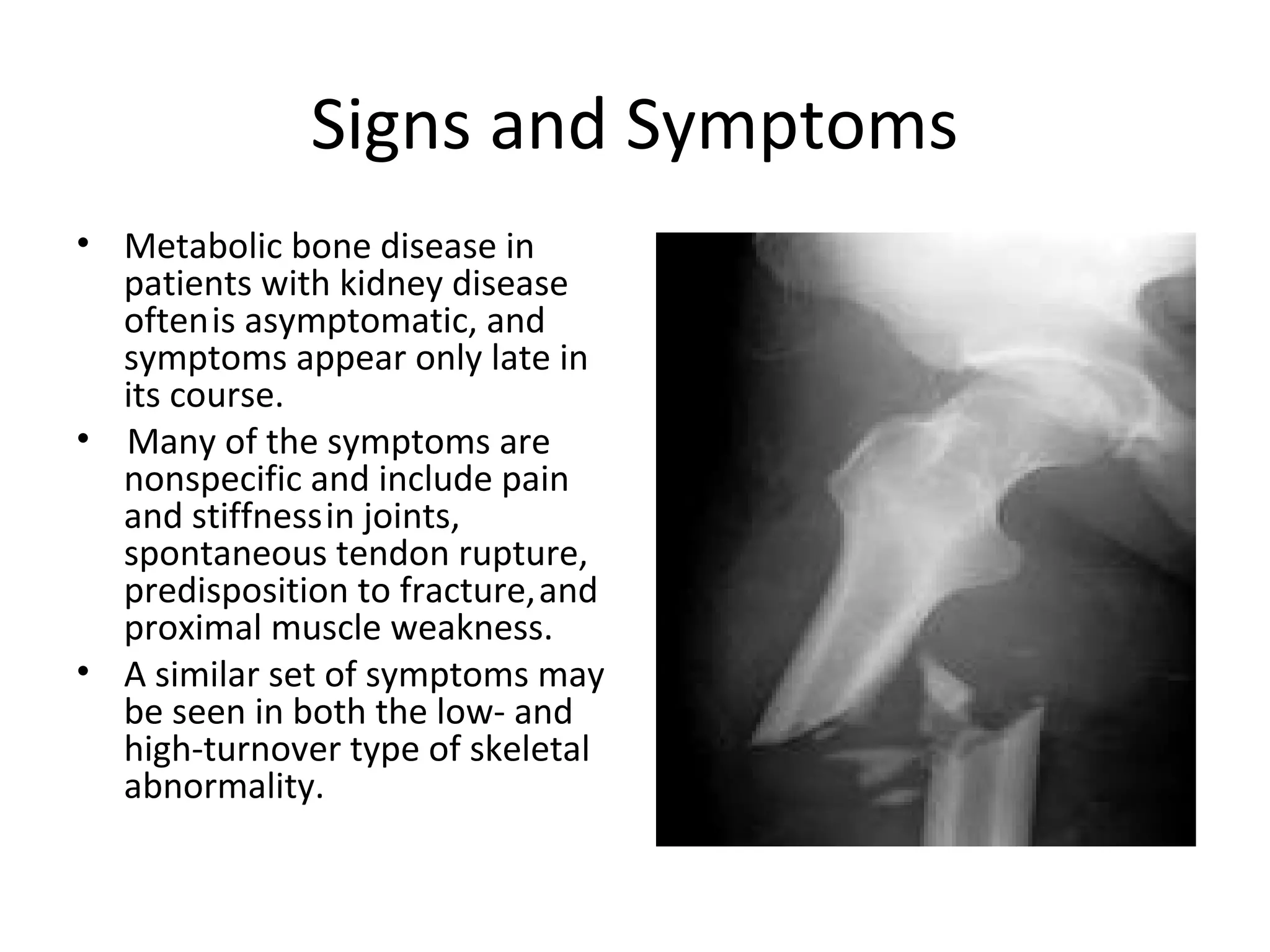 Signs and Symptoms
• Metabolic bone disease in
  patients with kidney disease
  often is asymptomatic, and
  symptoms appear only late in
  its course.
• Many of the symptoms are
  nonspecific and include pain
  and stiffness in joints,
  spontaneous tendon rupture,
  predisposition to fracture, and
  proximal muscle weakness.
• A similar set of symptoms may
  be seen in both the low- and
  high-turnover type of skeletal
  abnormality.
 